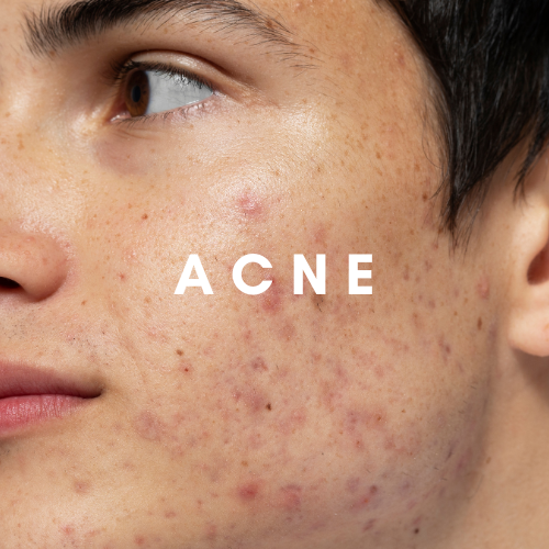 Acne Treatment Products