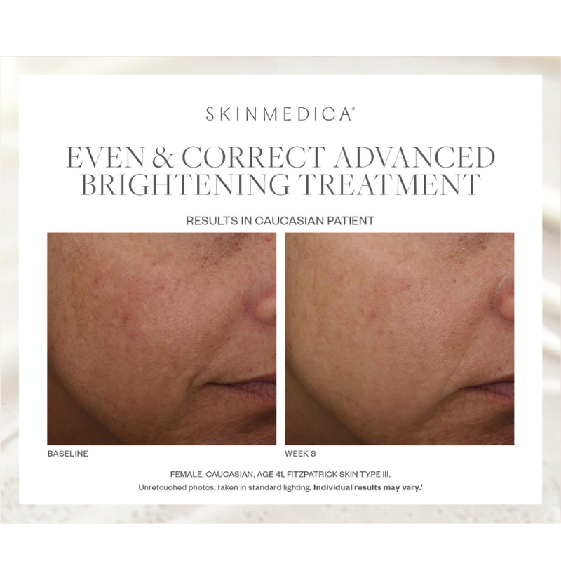 SkinMedica Even & Correct Advanced Brightening Treatment