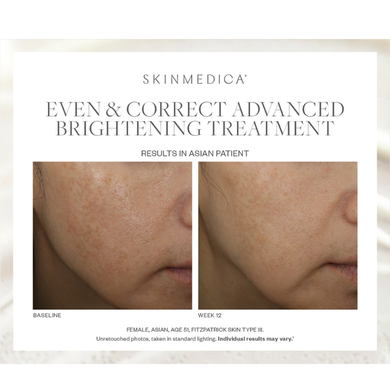 SkinMedica Even & Correct Advanced Brightening Treatment
