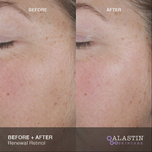 Load video: Alastin Renewal Retinol .25