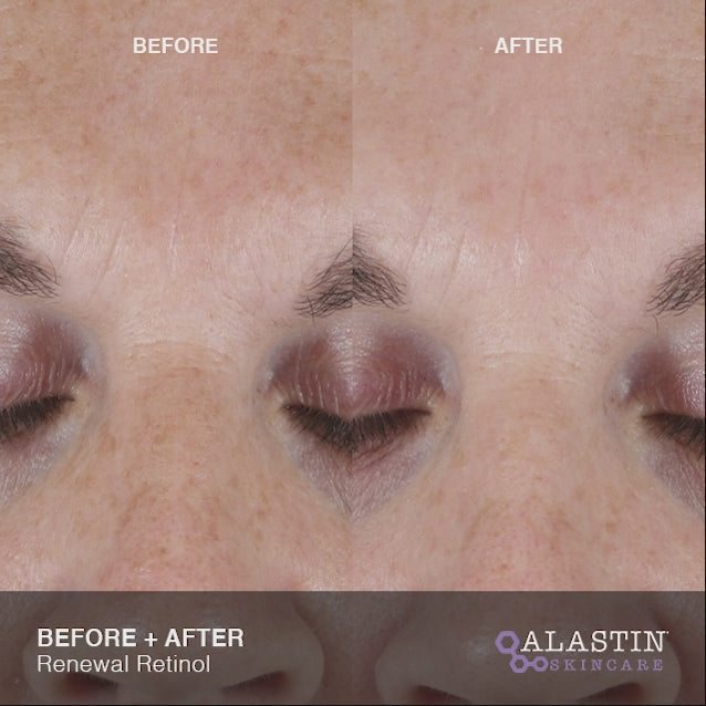 Load video: Alastin Renewal Retinol .25
